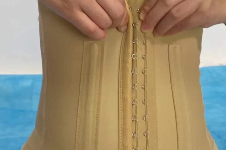 腰腹部脂肪抽吸术第5天效果图