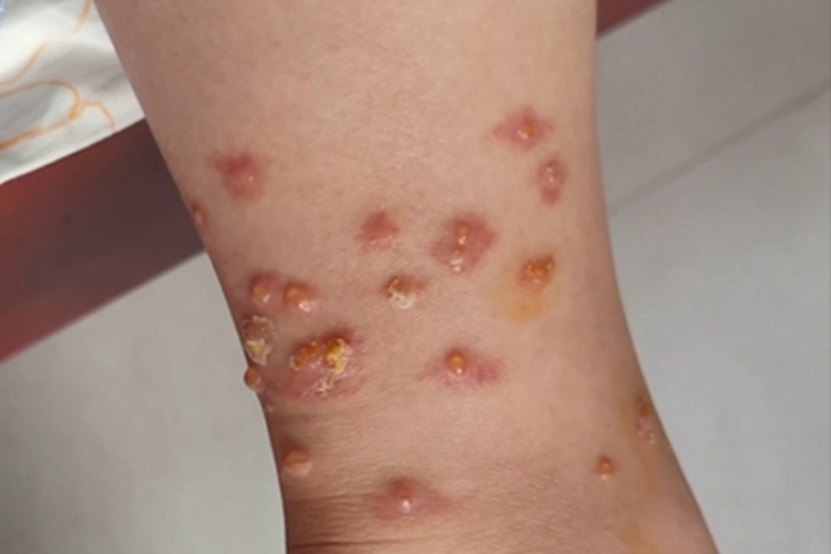 昆虫性皮炎小腿水疱图 昆虫性皮炎小腿水疱图