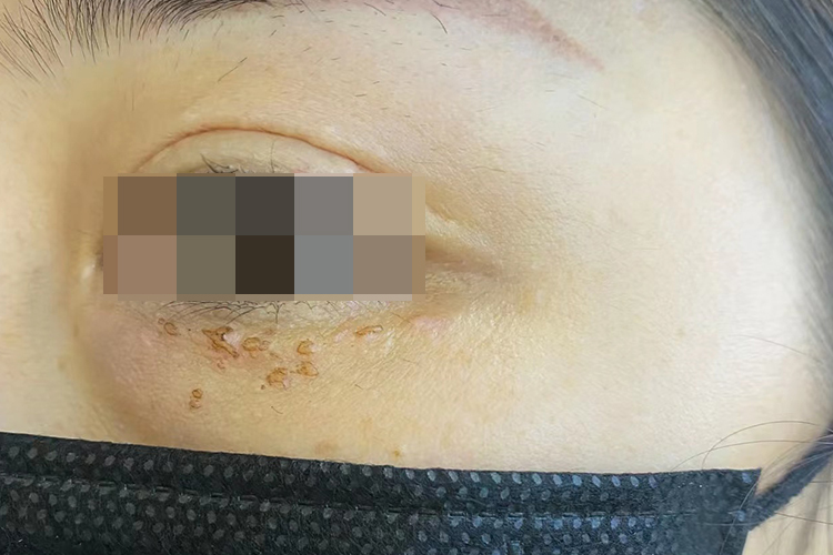 激光治疗后结痂逐渐脱落图