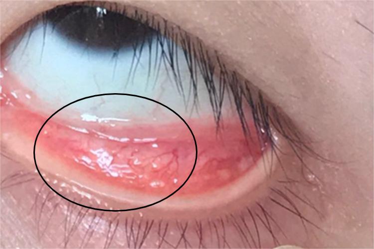 滤泡性结膜炎结膜疙瘩图 滤泡性结膜炎结膜疙瘩图