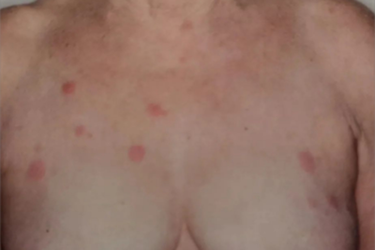 急性发热性嗜中性皮病胸部长斑图