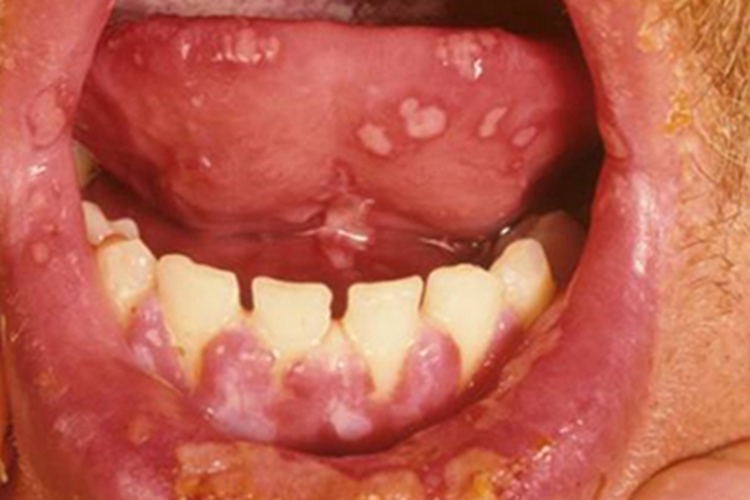 口腔溃疡舌头上有多个溃疡图 口腔溃疡舌头上有多个溃疡图