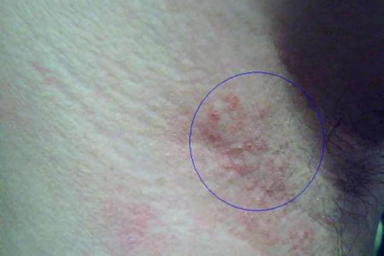 腋窝湿疹图 腋窝湿疹图