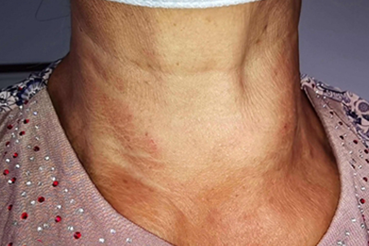 甲状腺腺瘤前颈包块