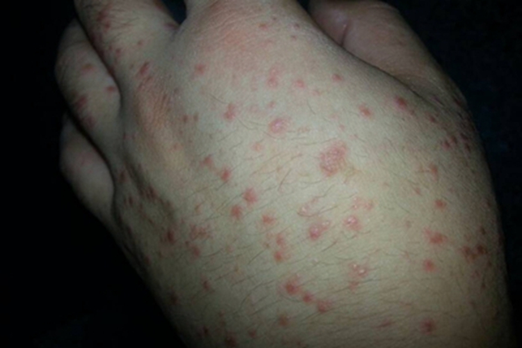麻疹手部小红疙瘩图