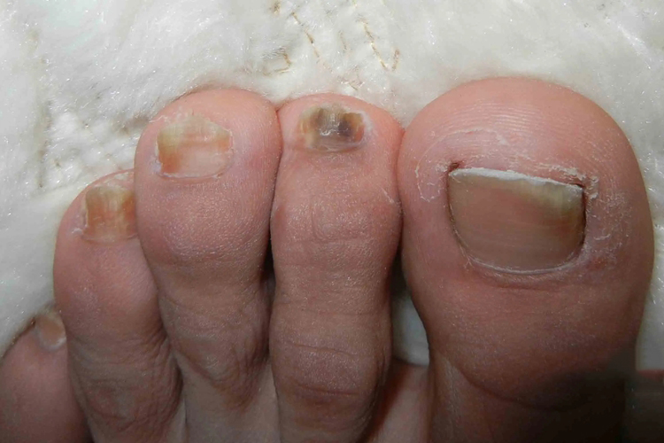 脚指甲被腐蚀凹凸不平图 脚指甲被腐蚀凹凸不平图