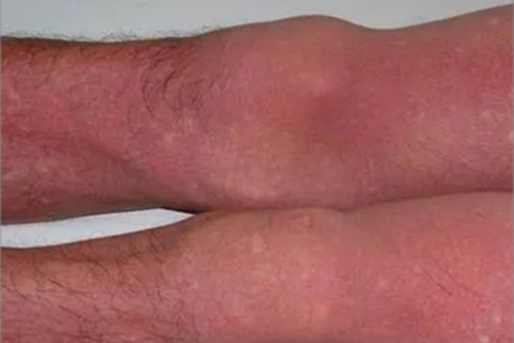 登革热双腿大面积红斑图