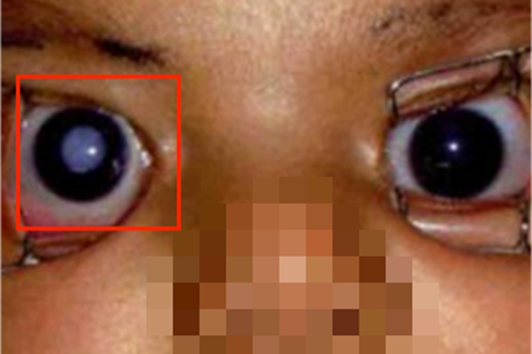 先天性风疹综合征瞳孔症状图