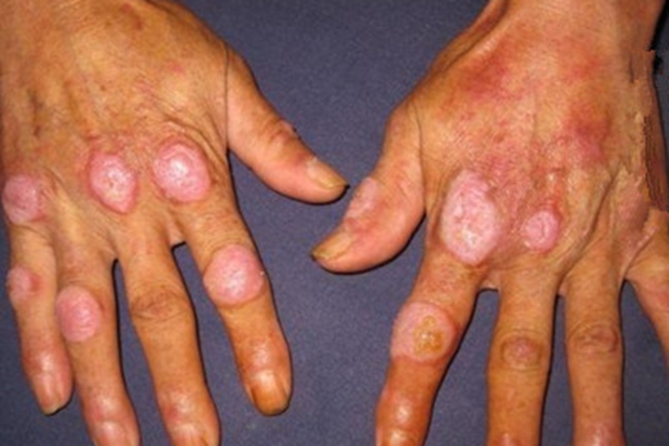 盘状红斑狼疮手部红斑图