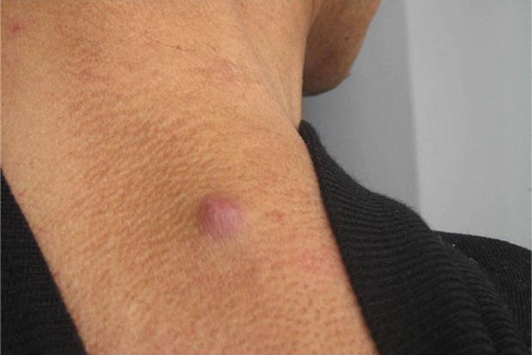 皮肤转移癌背部大红疙瘩图