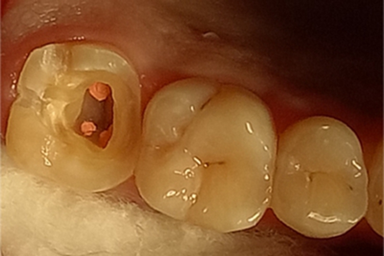 死髓牙牙齿龋洞图