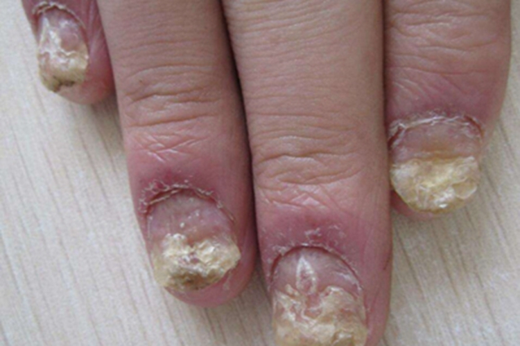 银屑病关节炎手指甲症状图