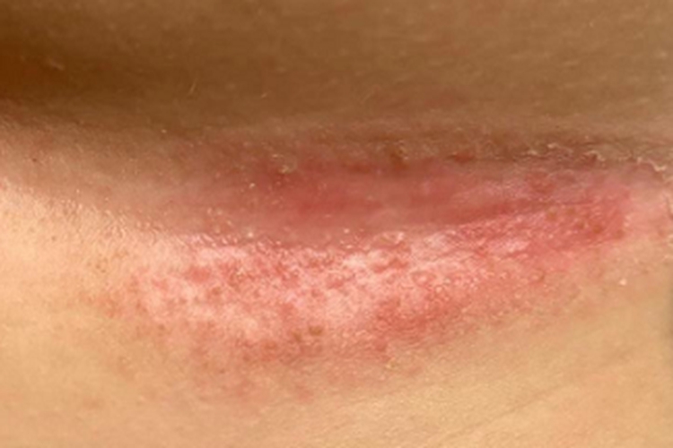 大腿根部内侧红痱图