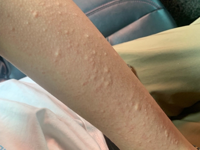 海鲜过敏胳膊上都是疙瘩图