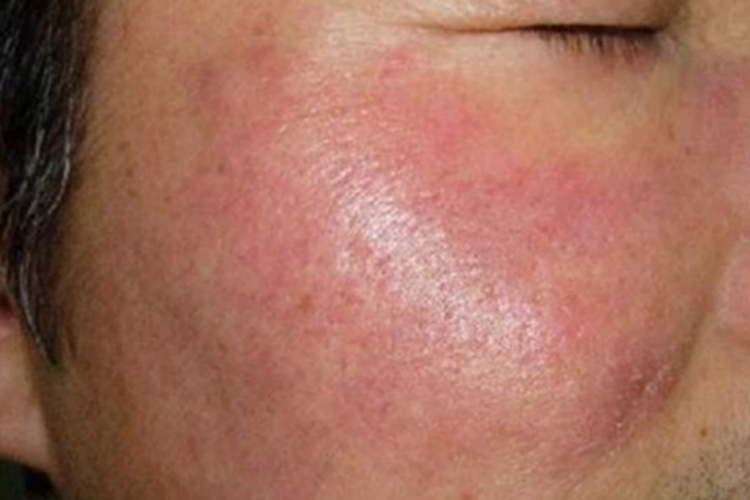 荨麻疹面部红肿图 荨麻疹面部红肿图