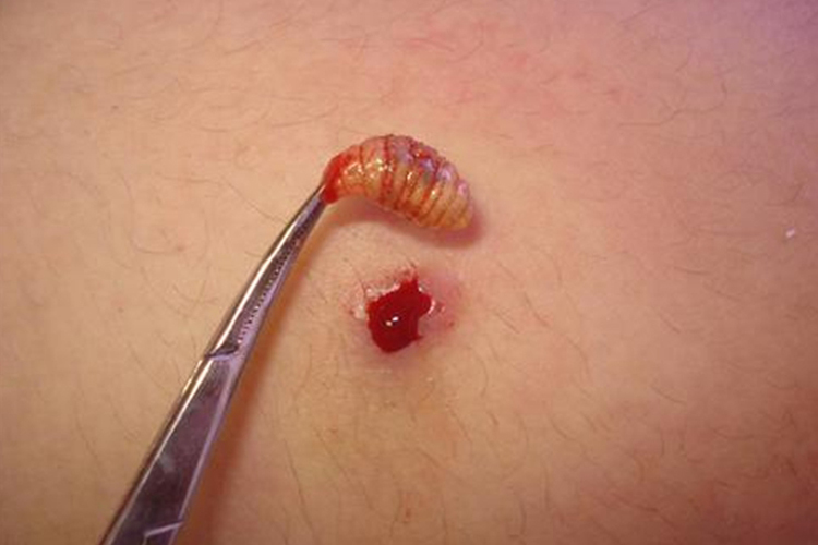 皮肤蝇蛆病疖肿型图