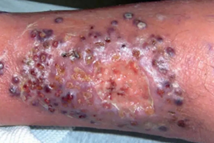 机会性原藻感染小腿糜烂图