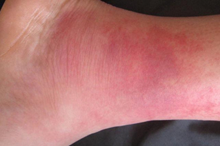 急性一氧化碳中毒脚踝红斑图 急性一氧化碳中毒脚踝红斑图