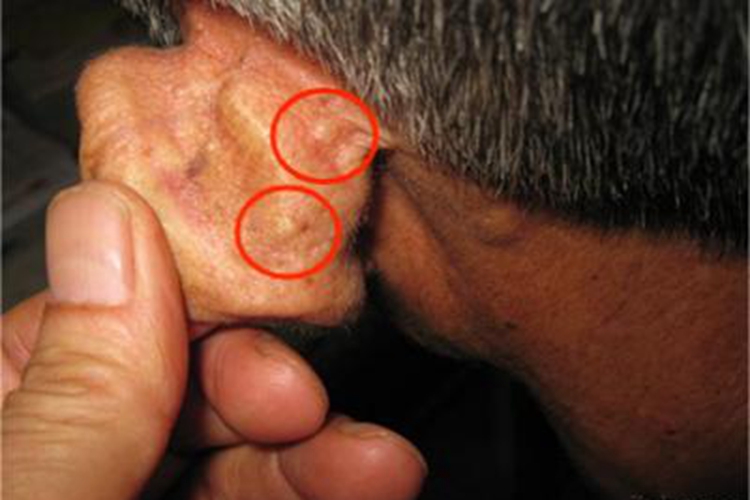 耳部弹性纤维结节耳后症状图