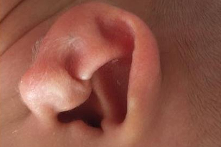 新生儿杯状耳图