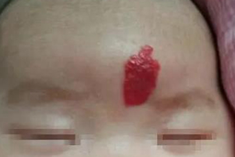 毛细血管瘤面部有块状红斑图 毛细血管瘤面部有块状红斑图