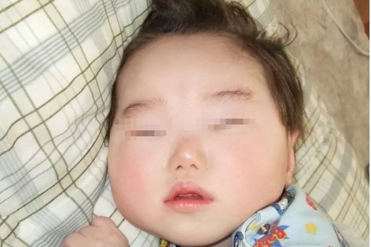 Menkes病患儿图 Menkes病患儿图