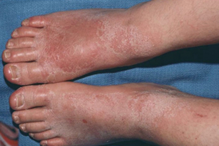 亚急性接触性皮炎脚背皮肤粗糙图