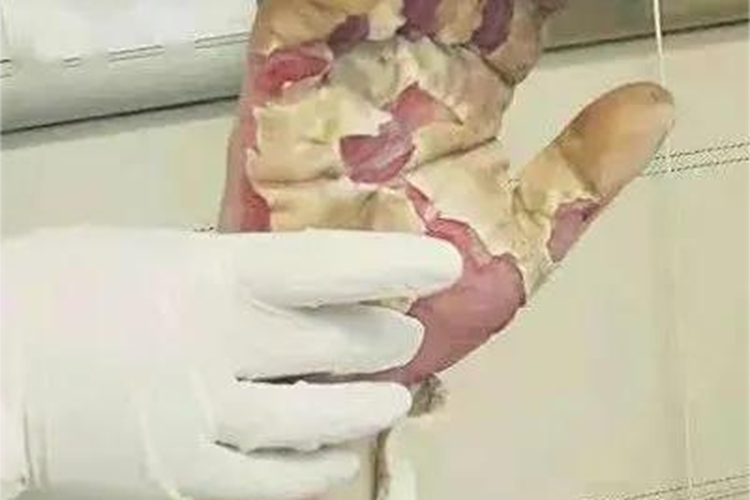Ⅲ度烧伤手部症状图