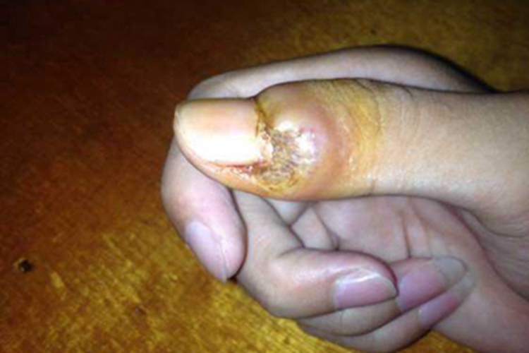 急性甲沟炎手指肿大变形图 急性甲沟炎手指肿大变形图