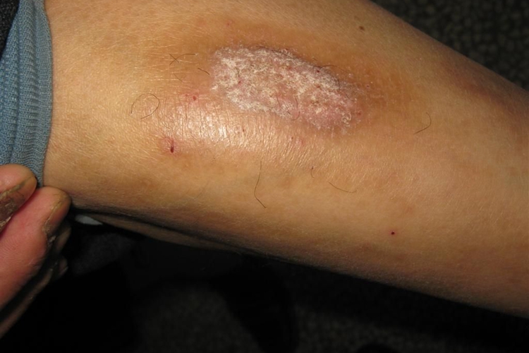 胳膊肘关节神经性皮炎图