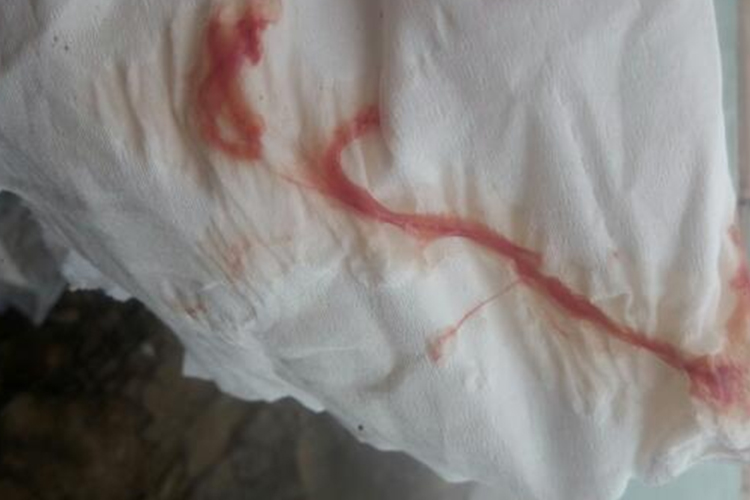 血性白带图 血性白带图