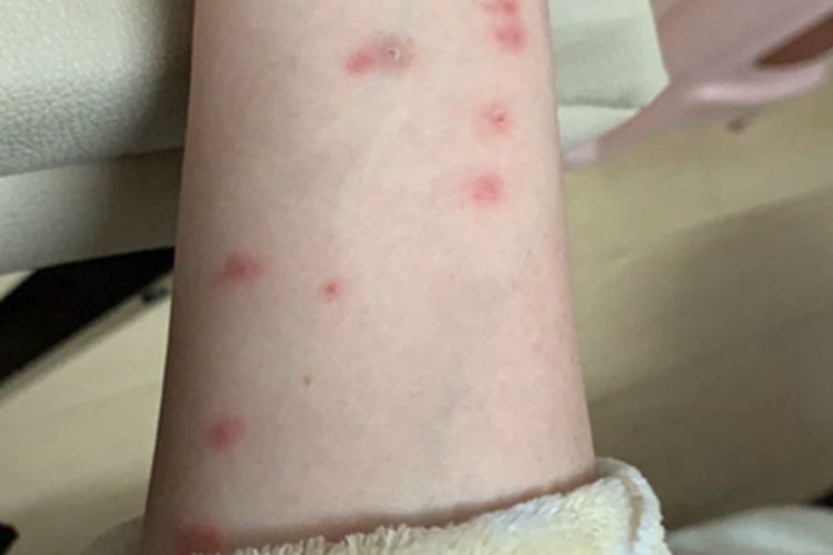 跳蚤叮咬红点图