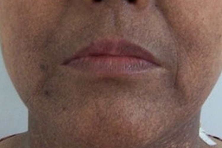 焦油黑变病口周皮肤发黑图 焦油黑变病口周皮肤发黑图