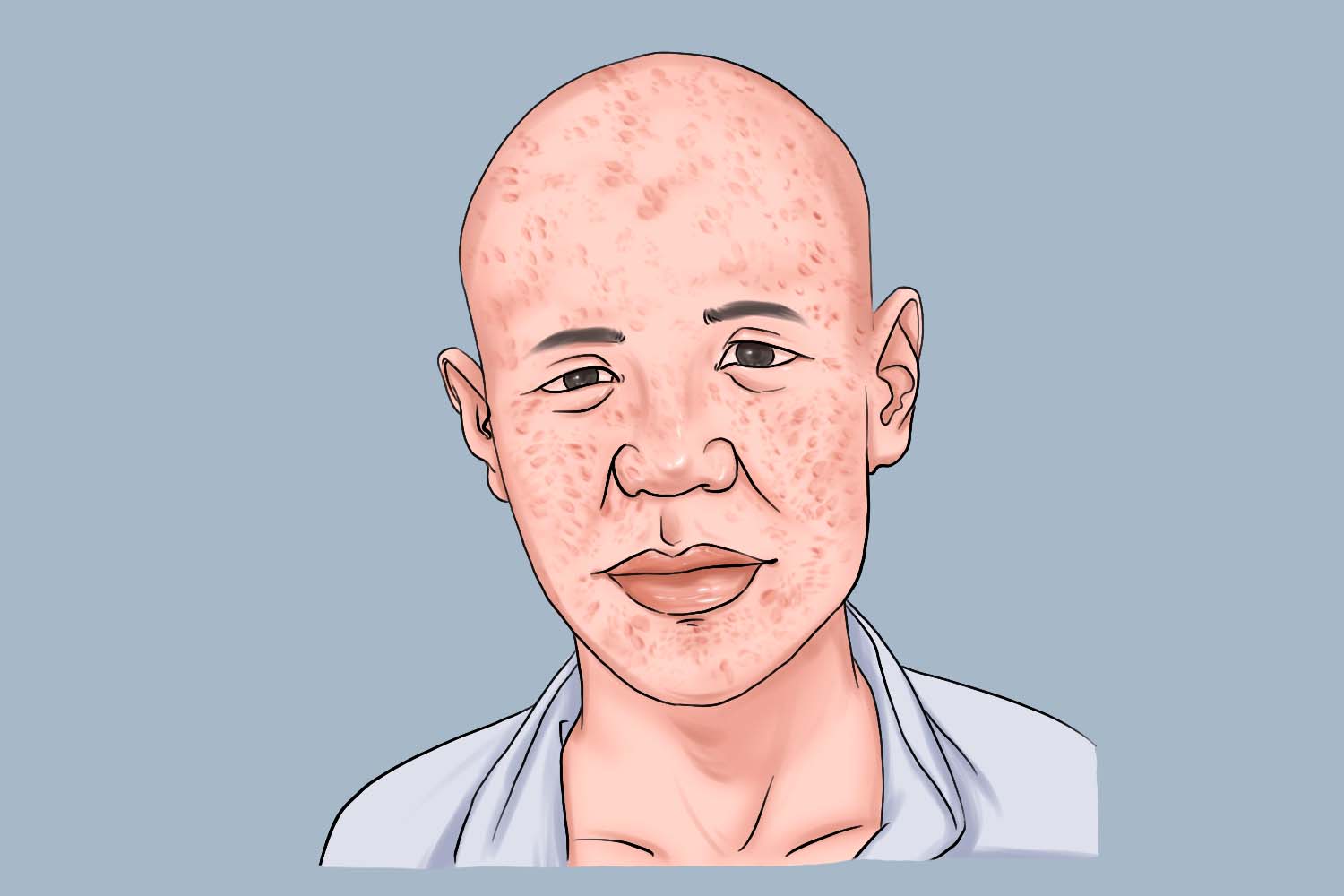 天花痊愈以后的样子图