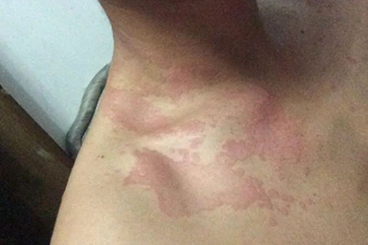 可变性红斑角化症胸部症状图