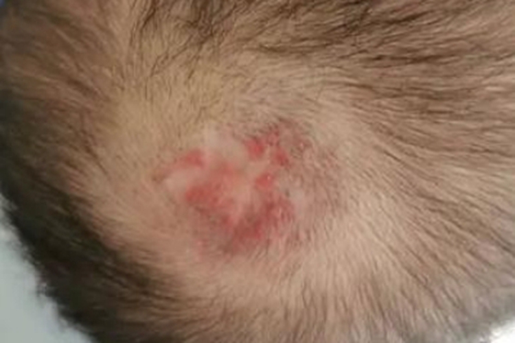 毛细血管瘤红点图 毛细血管瘤红点图