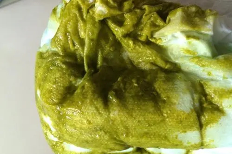 轮状病毒性胃肠炎大便稀图