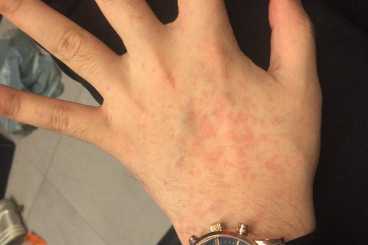 电焊过敏症状都有哪些图片_有来医生
