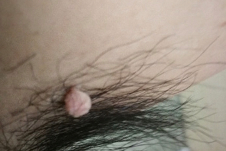 腋下寻常疣图 腋下寻常疣图