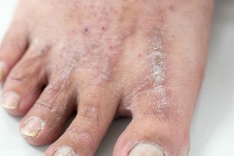 慢性苔藓样角化病脚背疙瘩图 慢性苔藓样角化病脚背疙瘩图