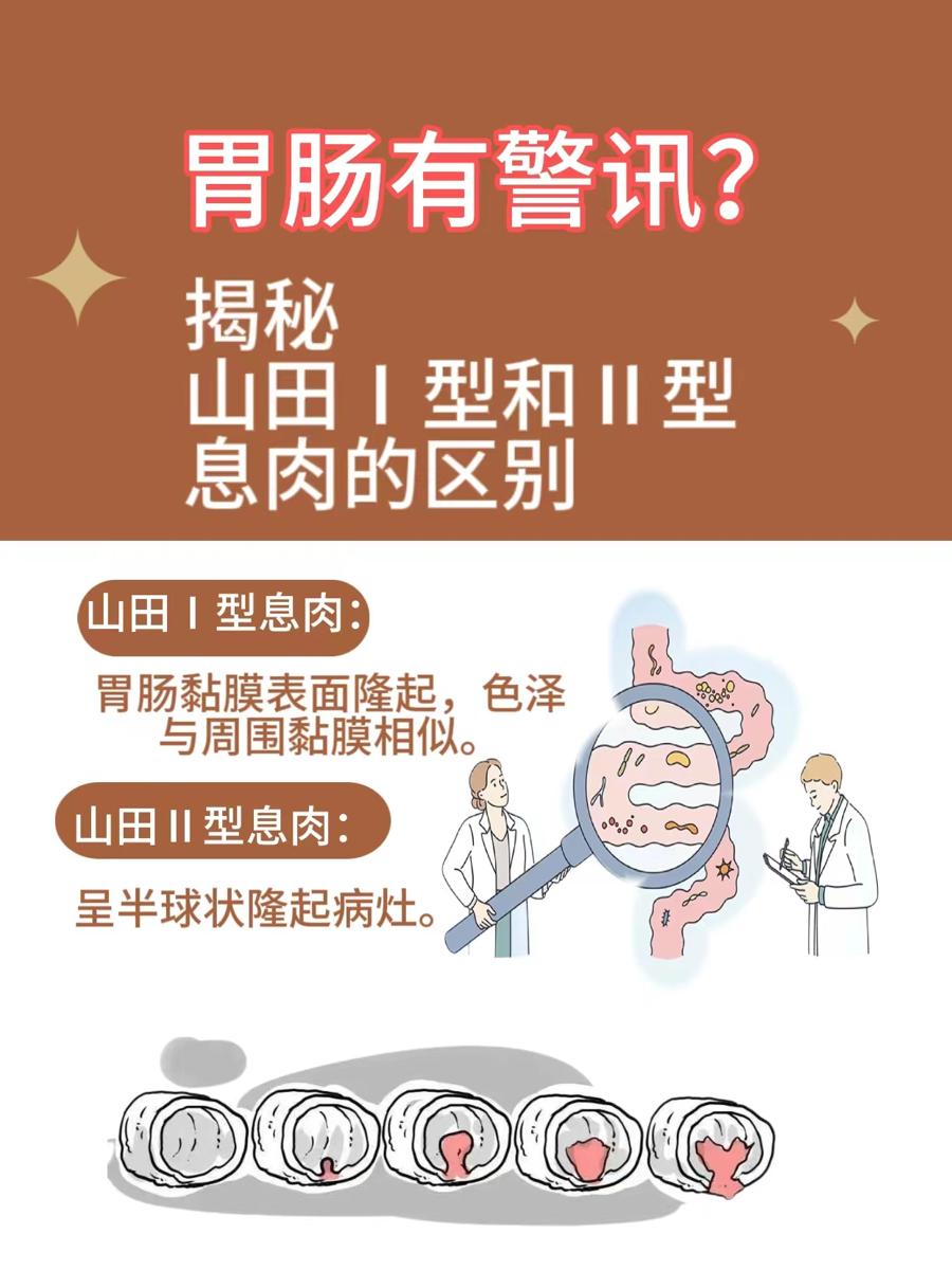 胃肠有警讯？揭秘山田Ⅰ型和Ⅱ型息肉的区别