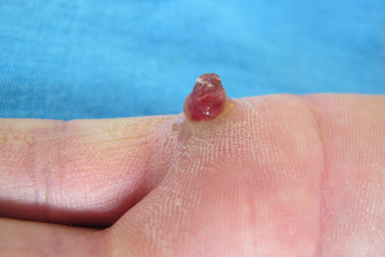 出血性肉芽肿图