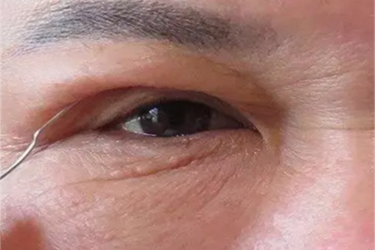 泪腺脱垂上眼皮后边肿了图