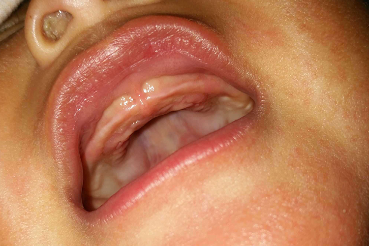 两个月宝宝正常牙龈图