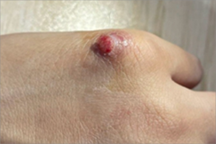 血管瘤手背小红疙瘩图