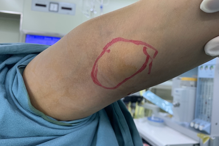 儿童腘窝囊肿有囊肿图