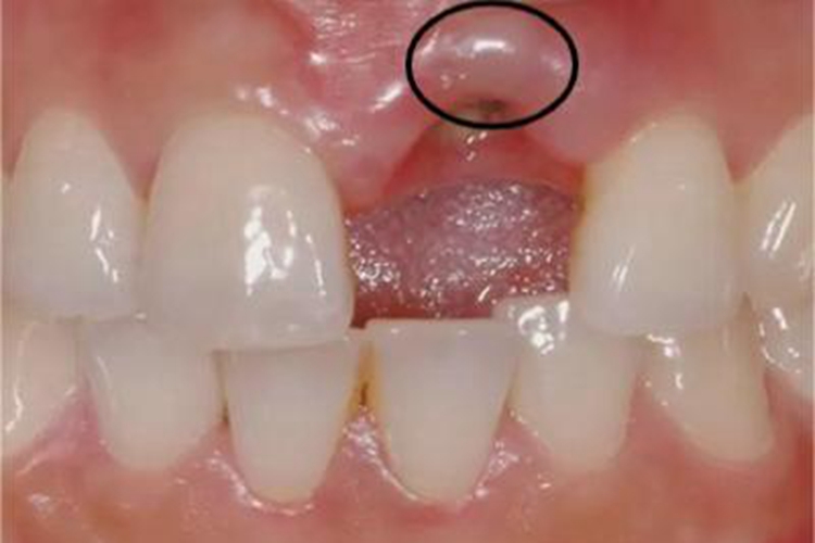 急性坏死性龈口炎小疙瘩图