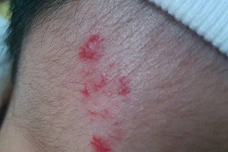 共济失调毛细血管扩张症红斑图 共济失调毛细血管扩张症红斑图