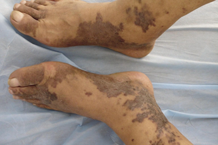 艾滋病皮肤肿瘤脚部症状图