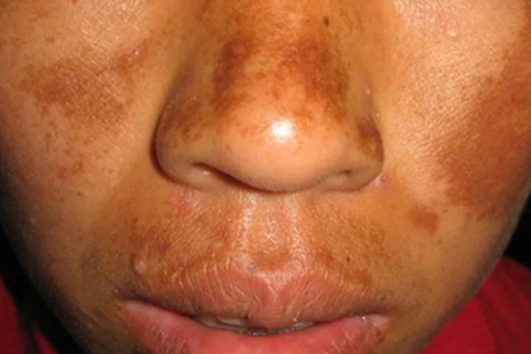 皮肤黑变病脸上有黄褐斑图